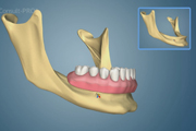 3D Denture with Bone Loss